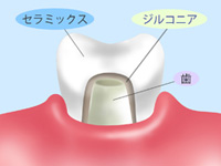 オールセラミック クラウン